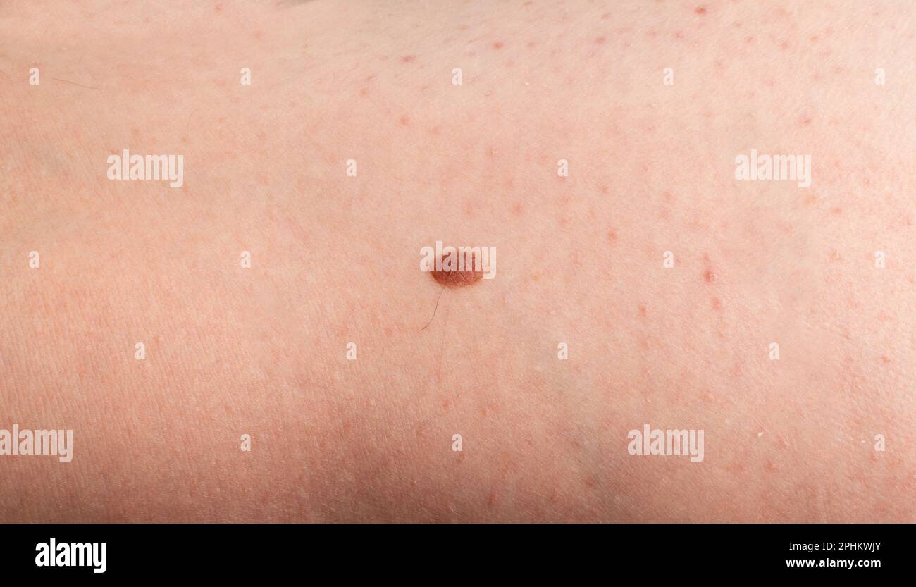 Skin mole closeup. Macro photo of blemish similar to melanoma, brown nevus, small birthmark, spot on human skin Stock Photo