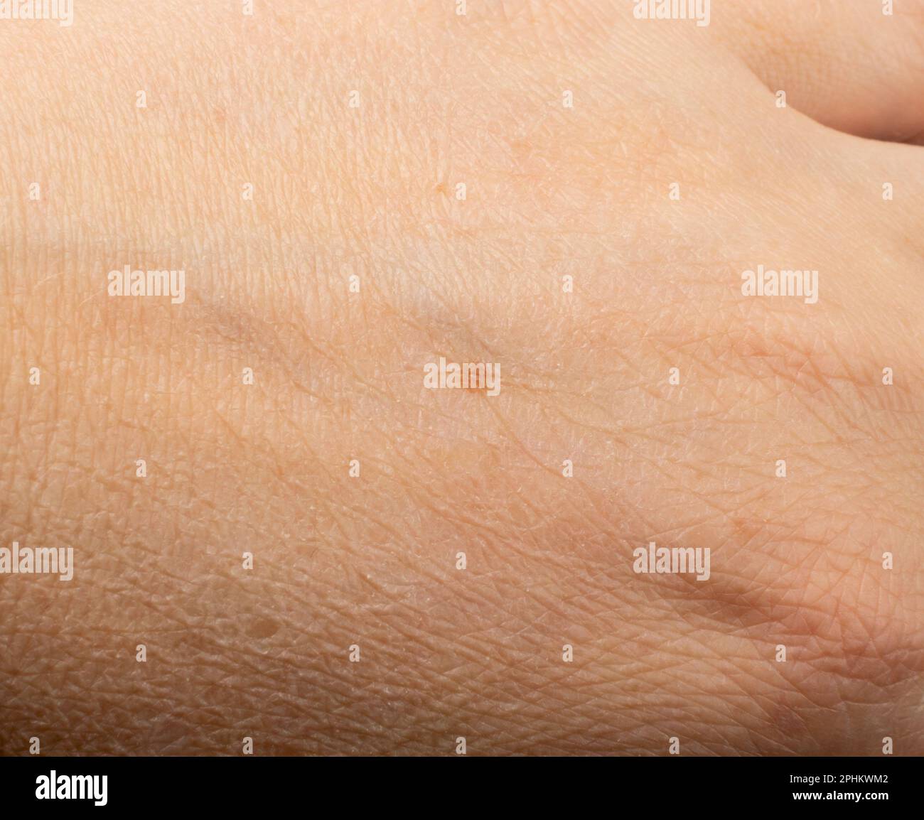 Skin mole closeup. Macro photo of blemish similar to melanoma, brown nevus, small birthmark, spot on human skin Stock Photo