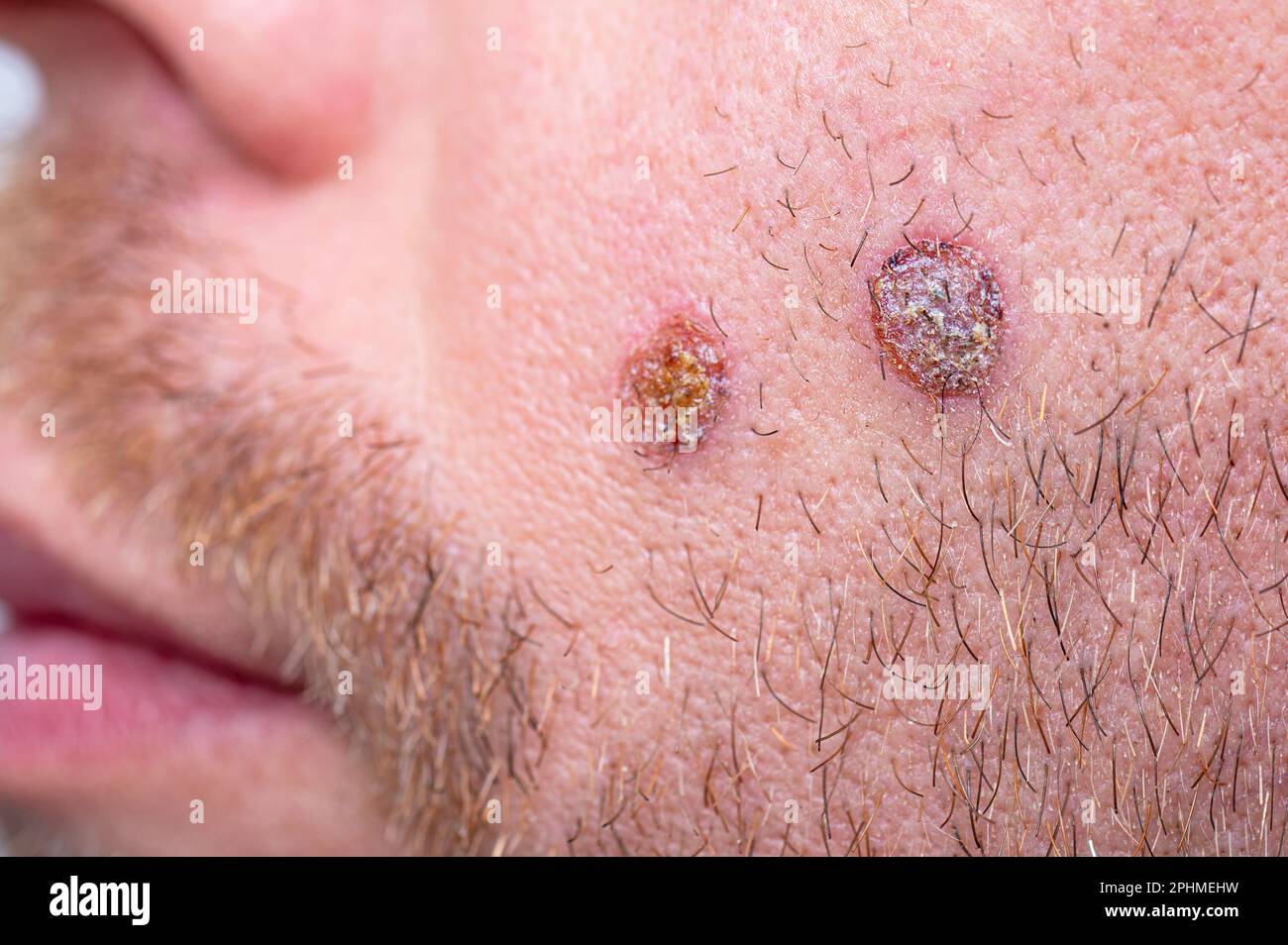Close-up of wound with scab on the face, selective focus Stock Photo
