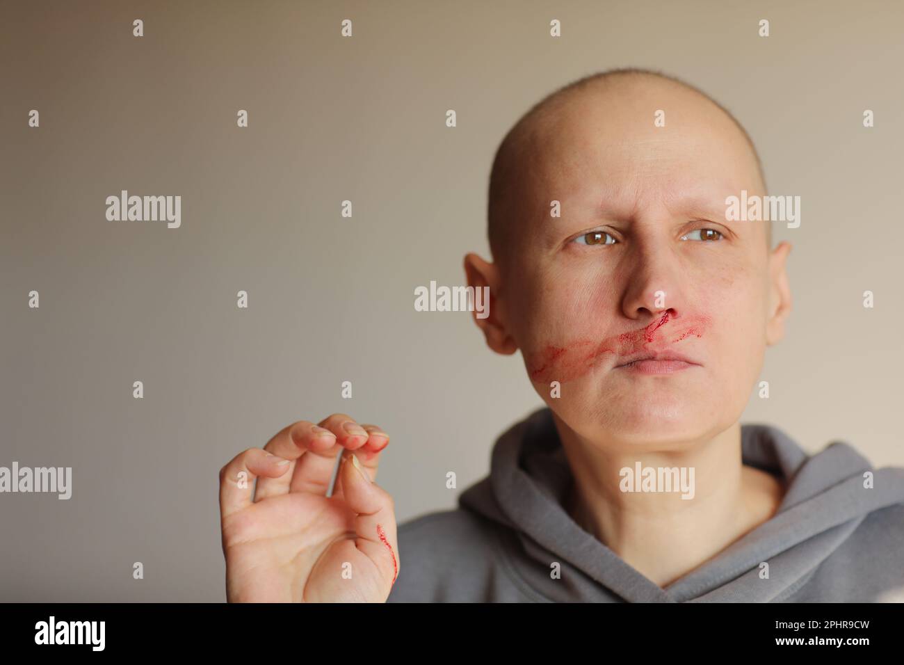 Hairless cancer sick female patient is bleeding from her nose, effects