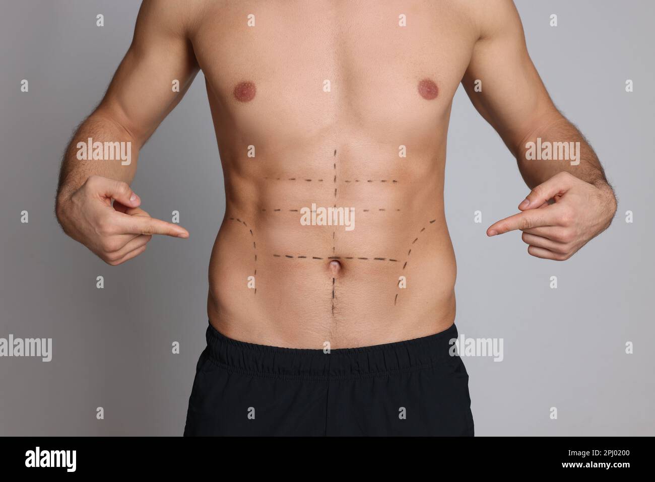 Fit man with marks on body against grey background, closeup. Weight loss surgery Stock Photo