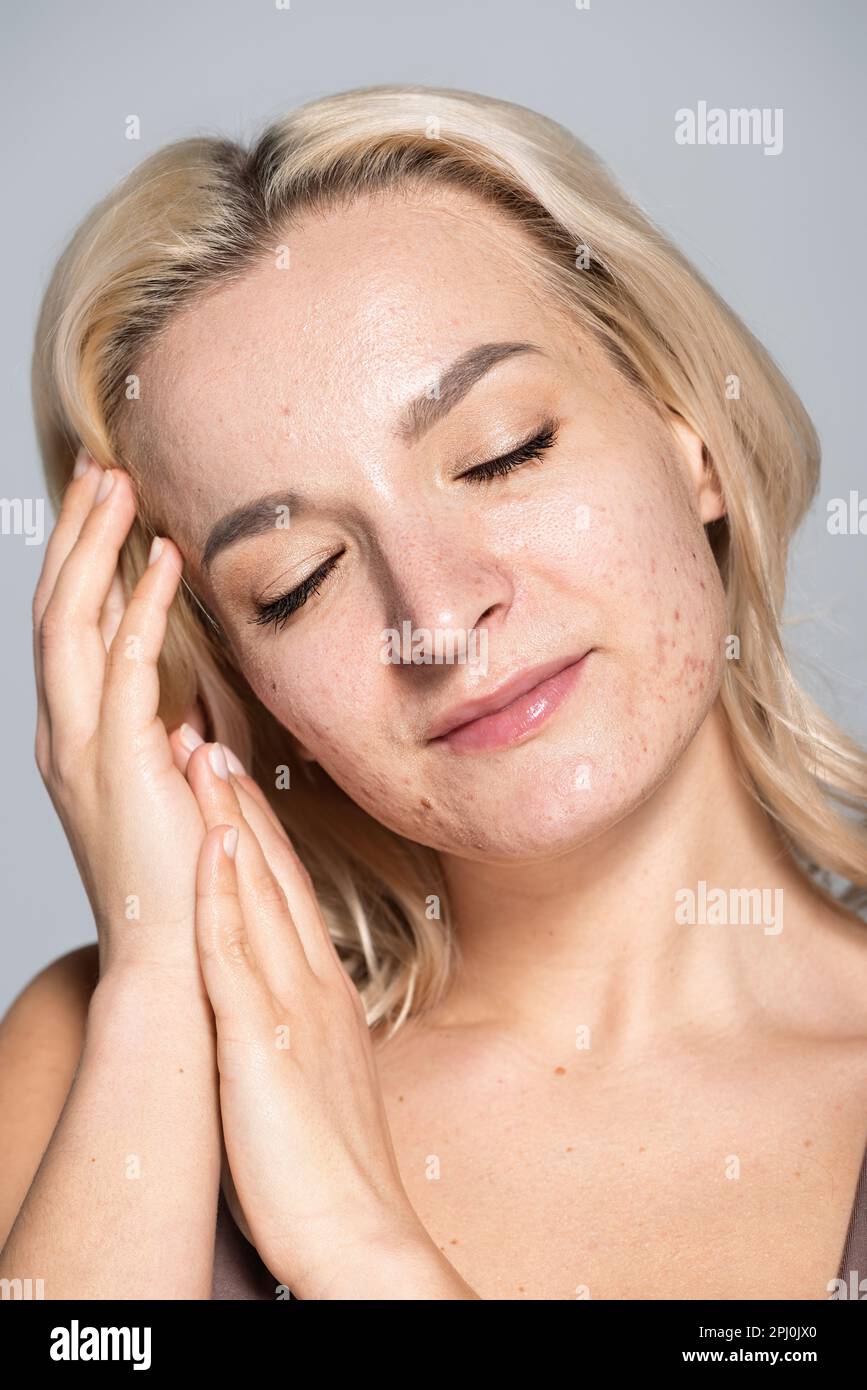 Condition skin on hands hi-res stock photography and images - Alamy