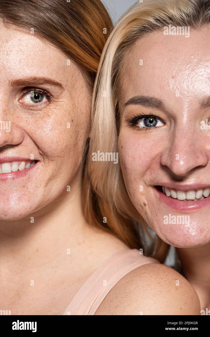 Cropped view of smiling women with skin issue looking at camera isolated on grey,stock image Stock Photo