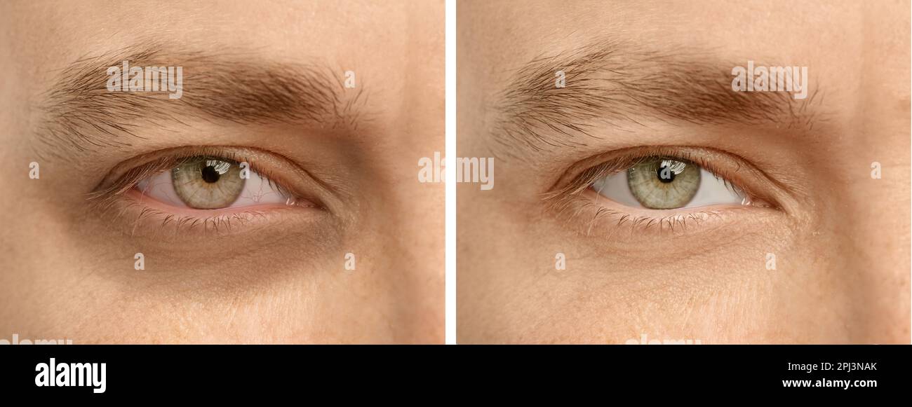 Collage with photos of tired man with dark circle under eye and after