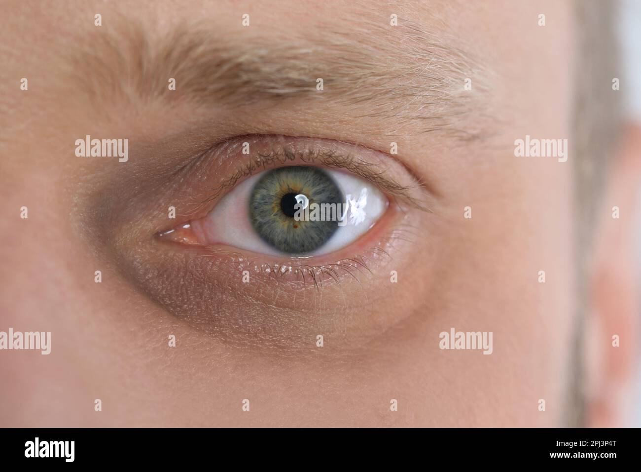 Tired man with dark circle under eye, closeup Stock Photo Alamy
