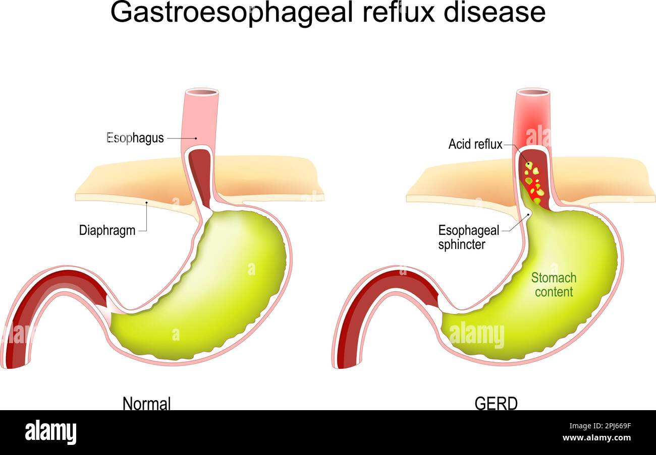 Gastroesophageal reflux disease. GERD. Cross section of human stomach. Normal internal organ and stomach with Acid reflux. Vector illustration Stock Vector