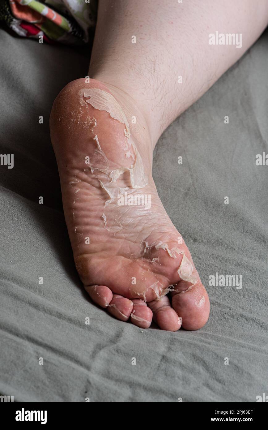 Skin peeling off a foot Stock Photo - Alamy