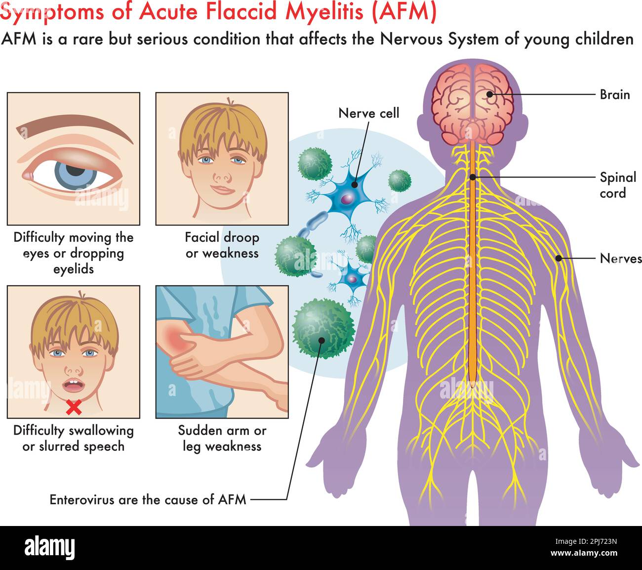 Medical illustration of Symptoms of Acute Flaccid Myelitis (AFM), with annotations. Stock Vector