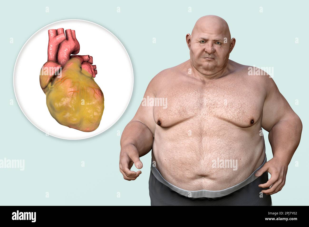 Fatty heart in overweight man, illustration. Stock Photo
