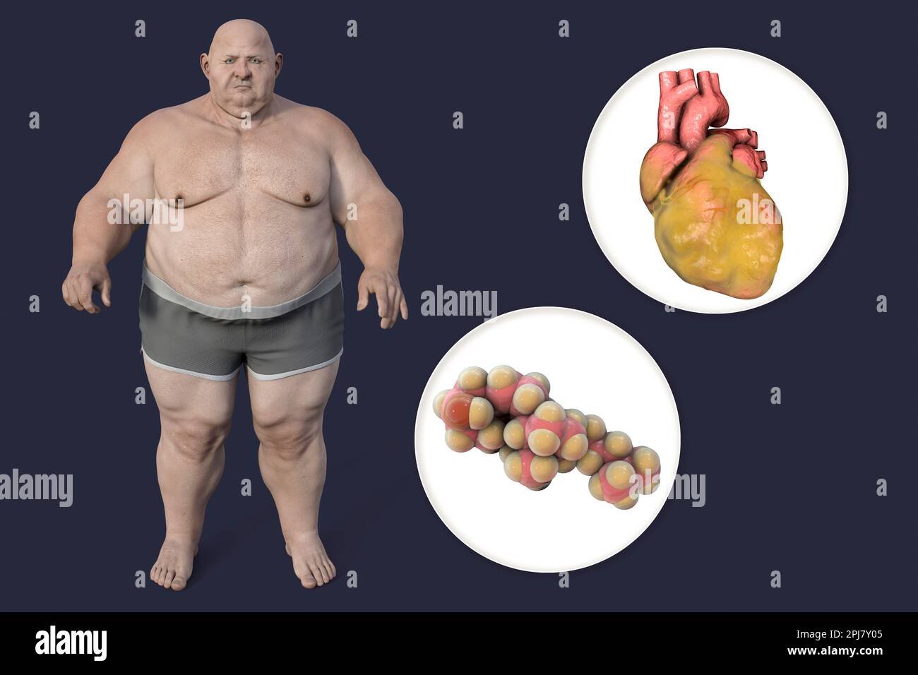 Cholesterol and fatty heart in overweight man, illustration Stock Photo