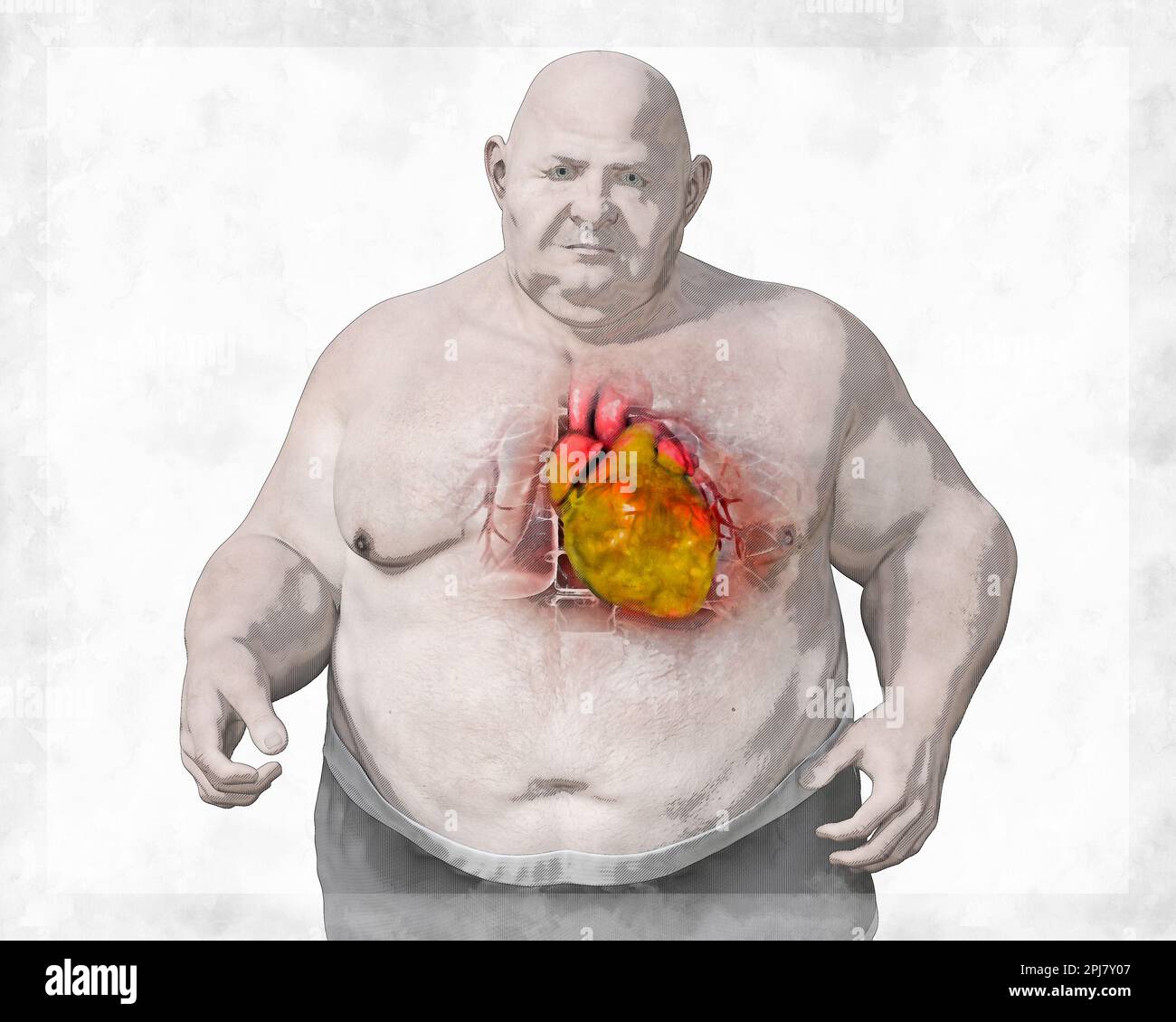 Myocardial lipidosis hi res stock photography and images Alamy Myocardial lipidosis hi res stock photography and images Alamy