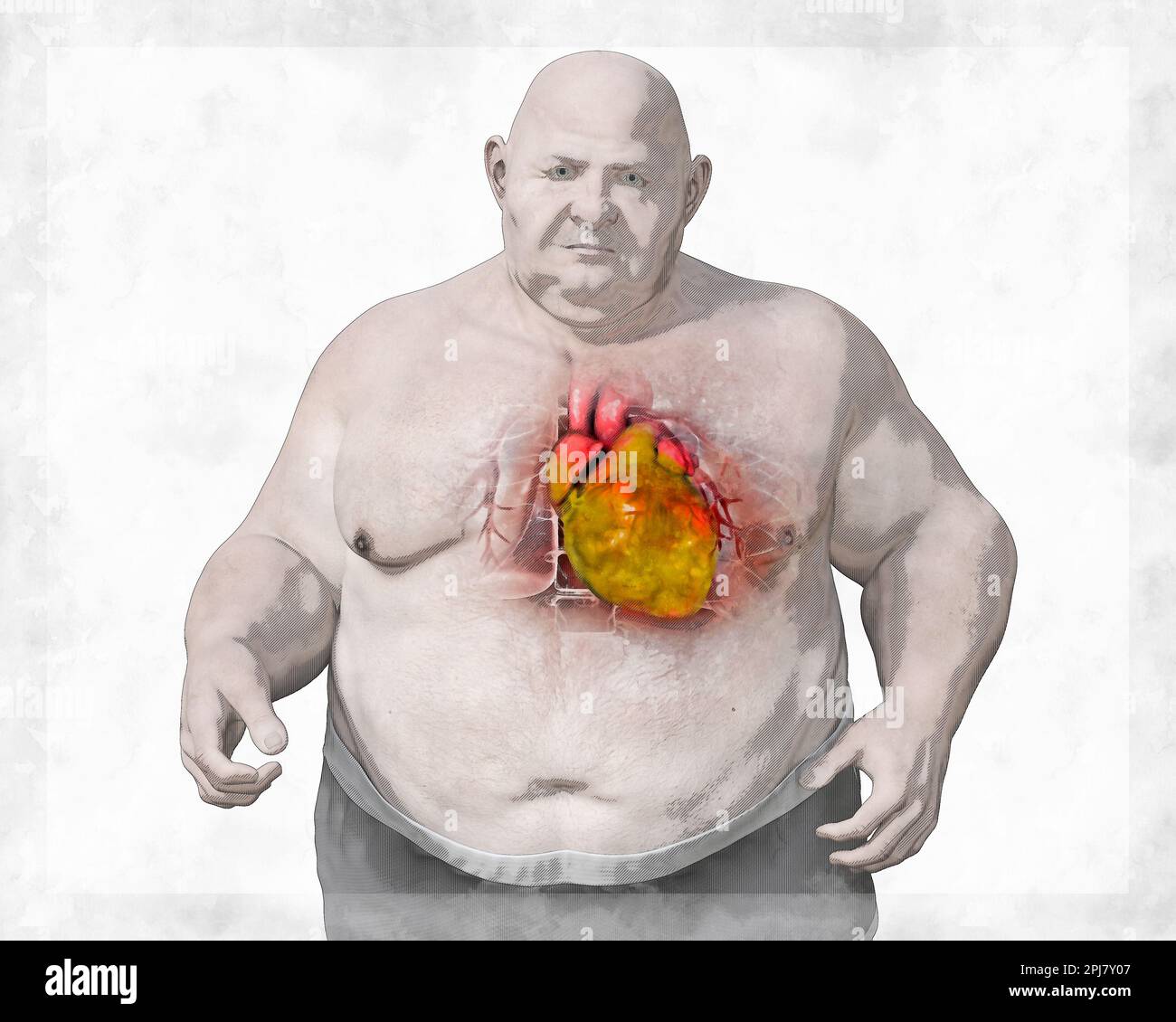 Fatty heart in overweight man, illustration. Stock Photo