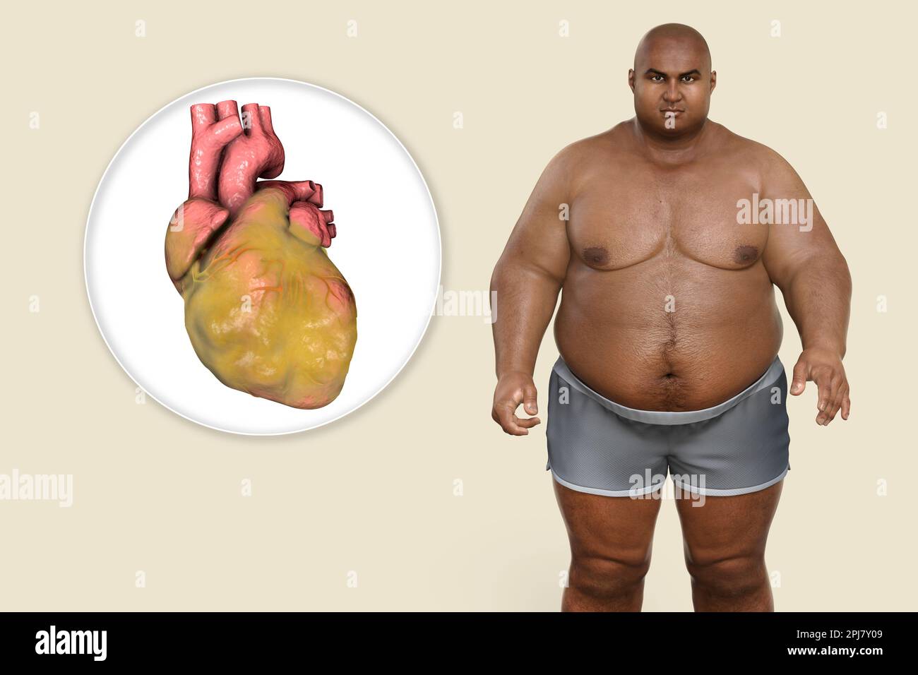 Fatty heart in overweight man, illustration. Stock Photo