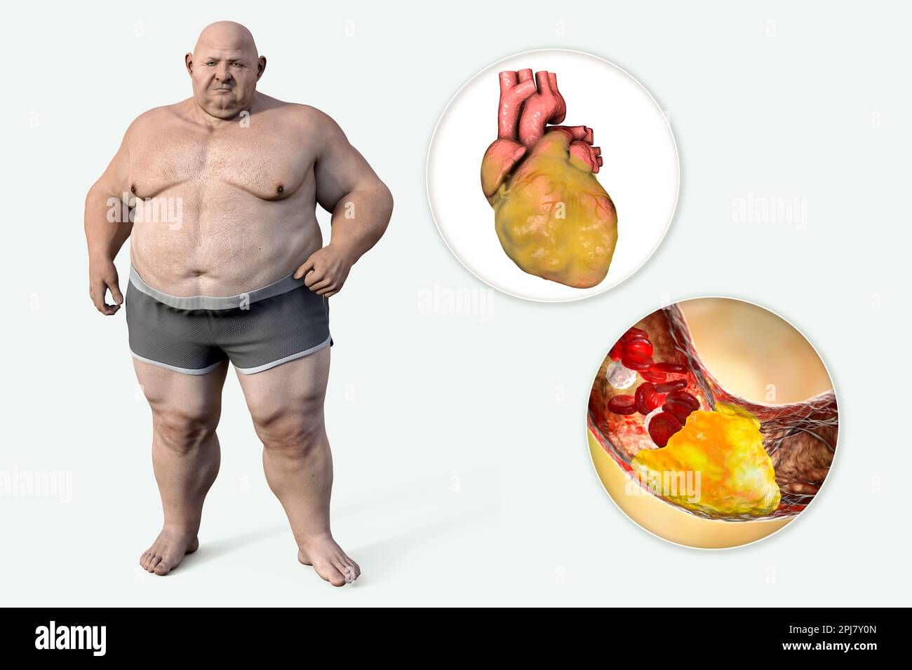 Atherosclerosis in a fatty heart, conceptual illustration Stock Photo