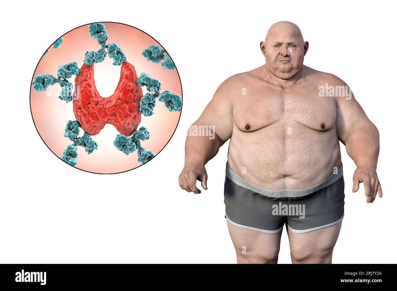 Autoimmune thyroid disease and obesity, illustration Stock Photo