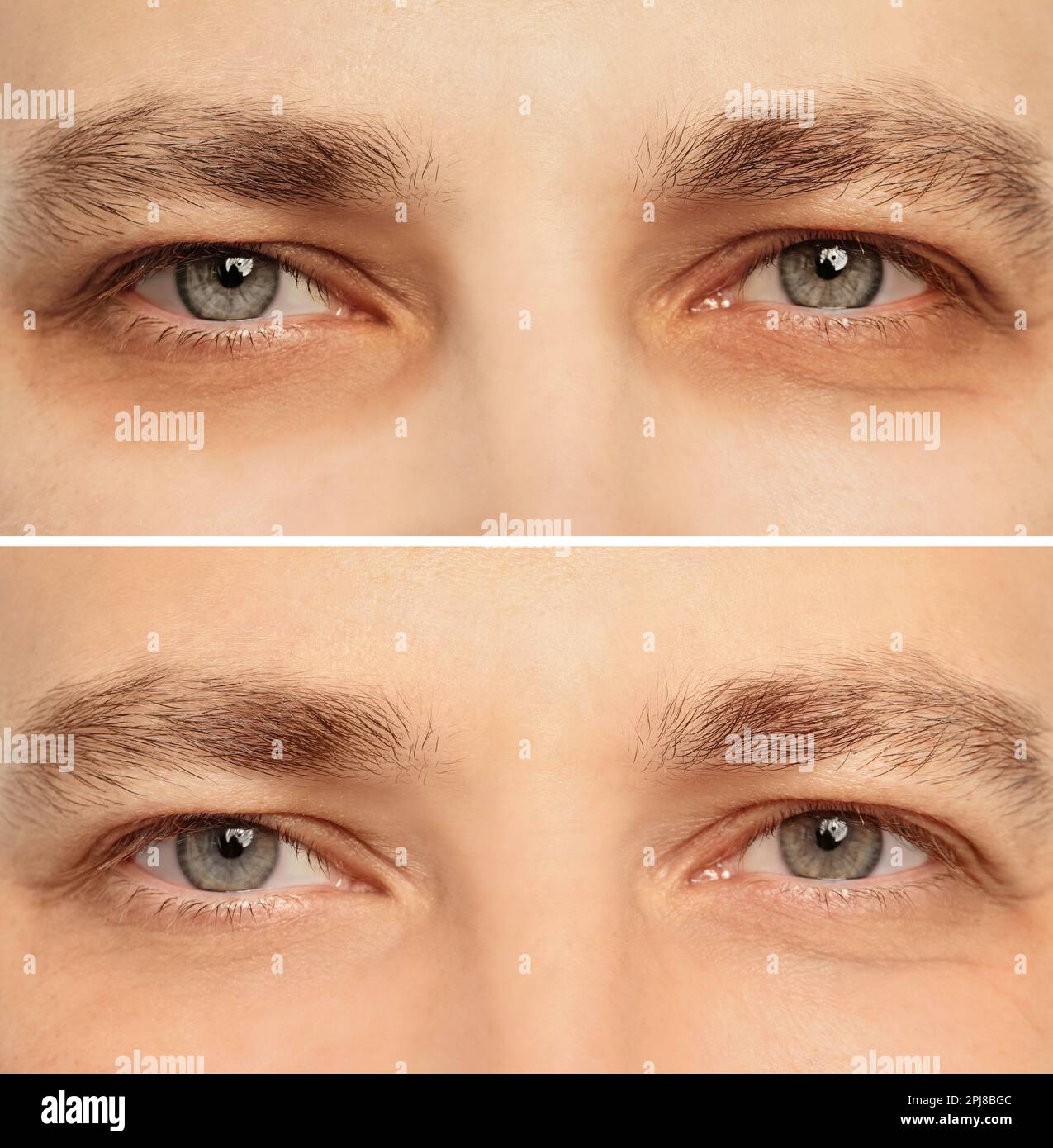 Collage with photos of tired man with dark circle under eye and after