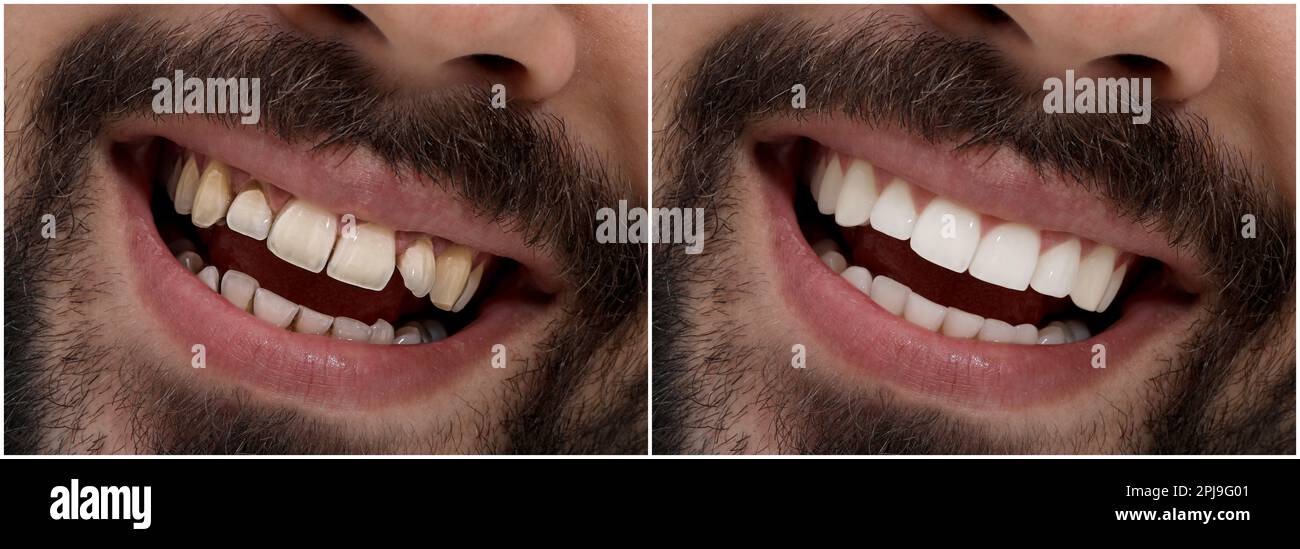 Collage with photos of young man before and after dental treatment ...