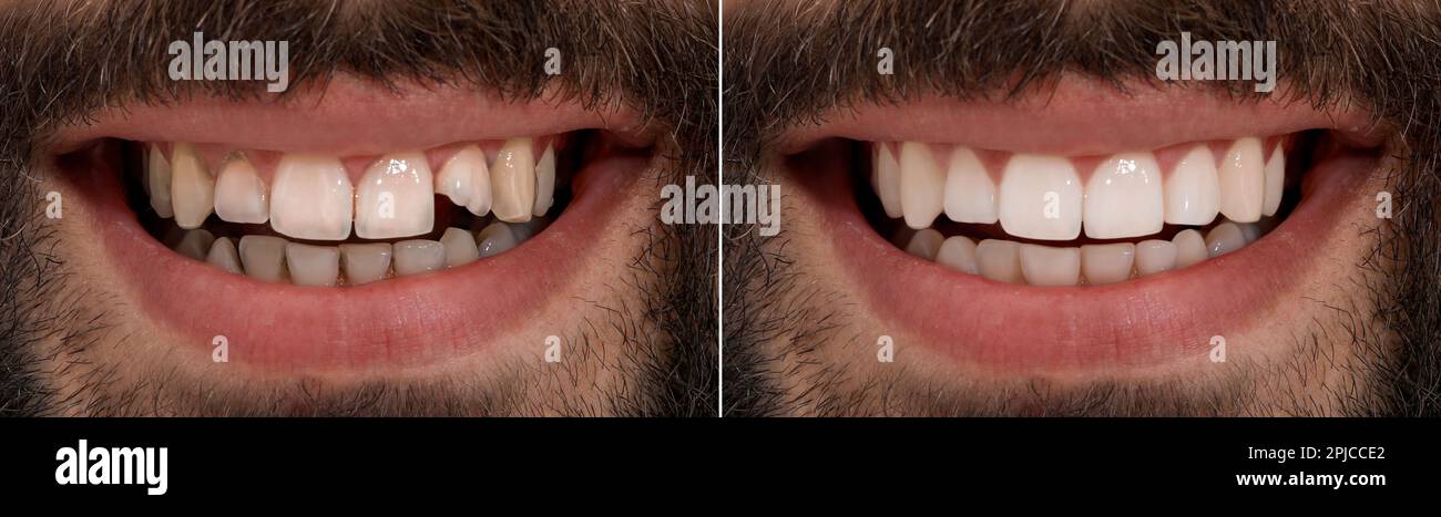 Collage with photos of young man before and after dental treatment ...