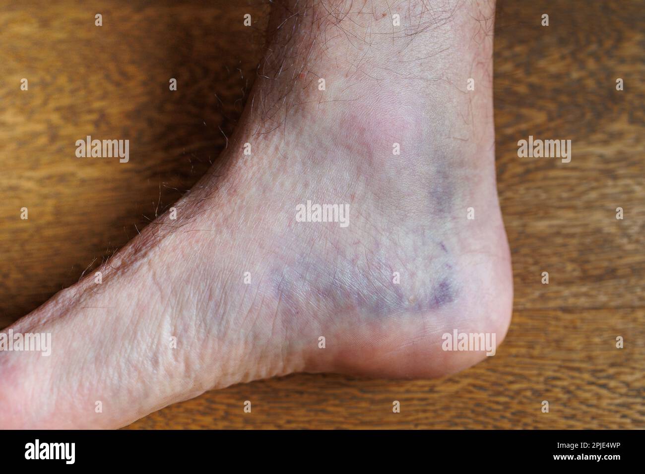 Large Bruise in the Heel of the Foot after a Stretching Injury Stock