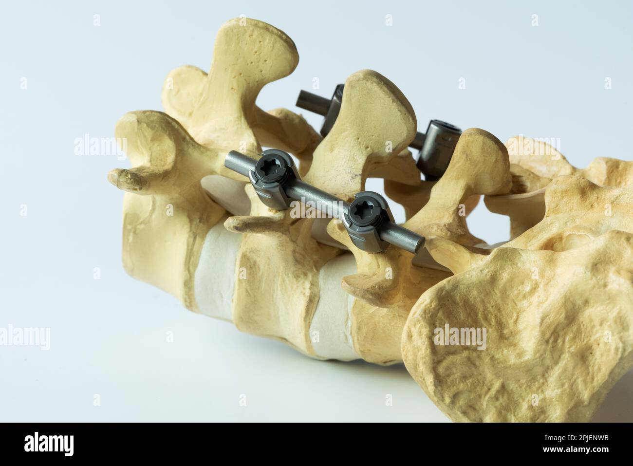 Close-up view instrument fixation of lumbar spine model on white background. Stock Photo