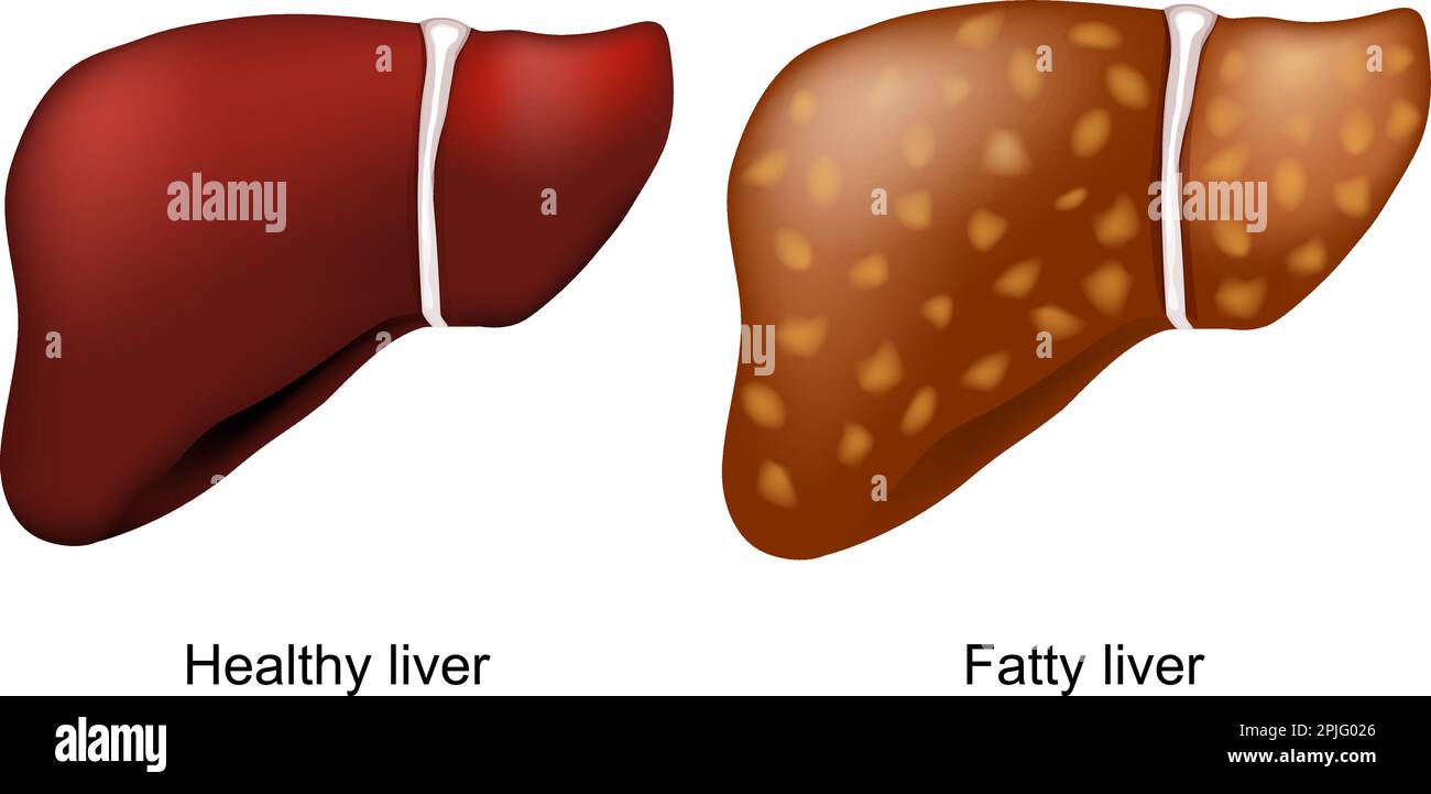 fatty liver disease. Healthy liver and hepatic steatosis. condition