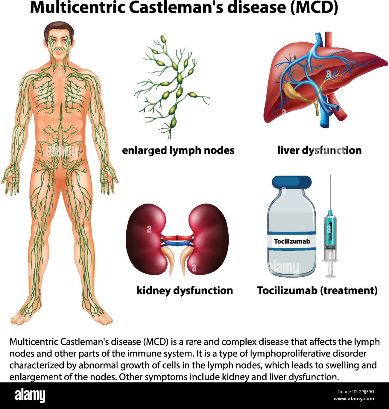 Multicentric Castlemans Disease (MCD) Infographic illustration Stock ...