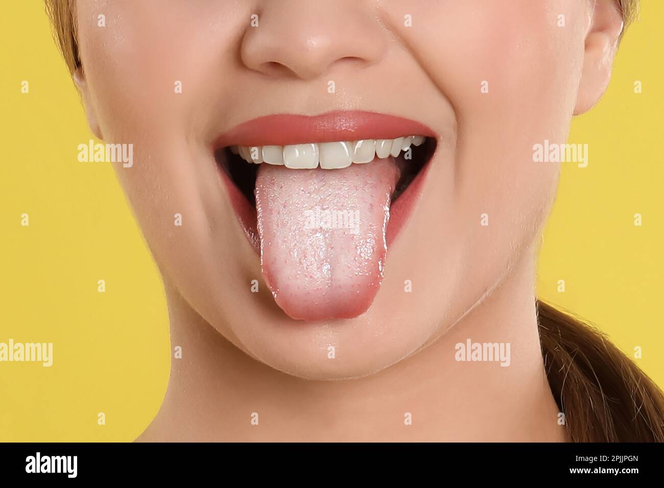 Young woman showing tongue with white patches on yellow background, closeup. Oral candidiasis (thrush) disease Stock Photo