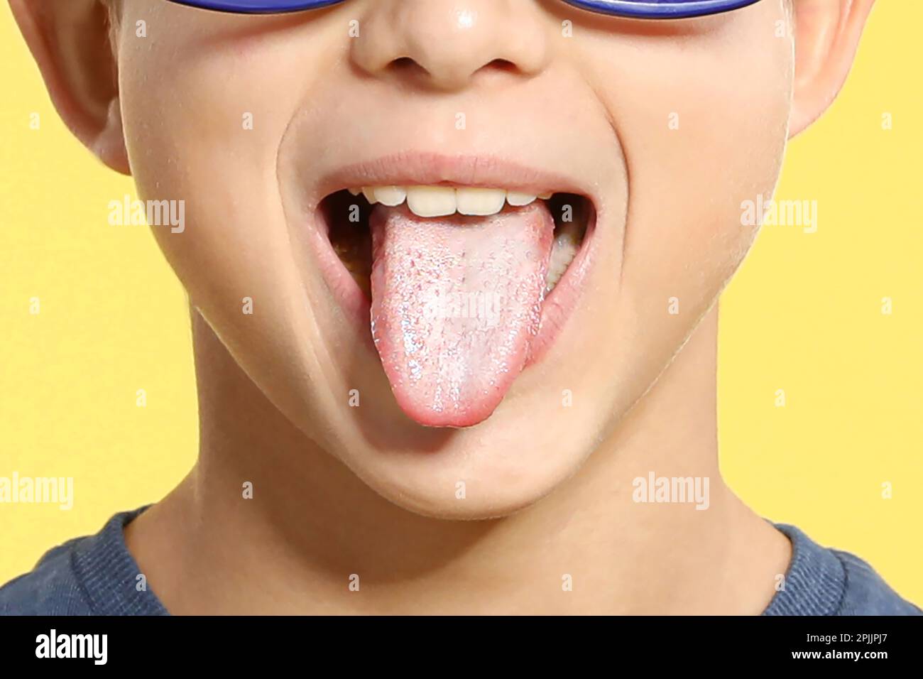 Boy showing tongue with white patches on yellow background, closeup. Oral candidiasis (thrush) disease Stock Photo