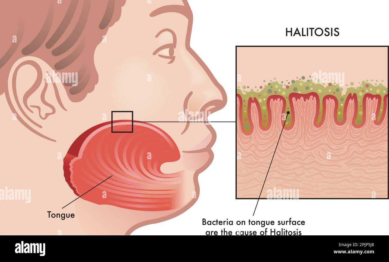 Medical illustration of the cause of Halitosis Stock Vector