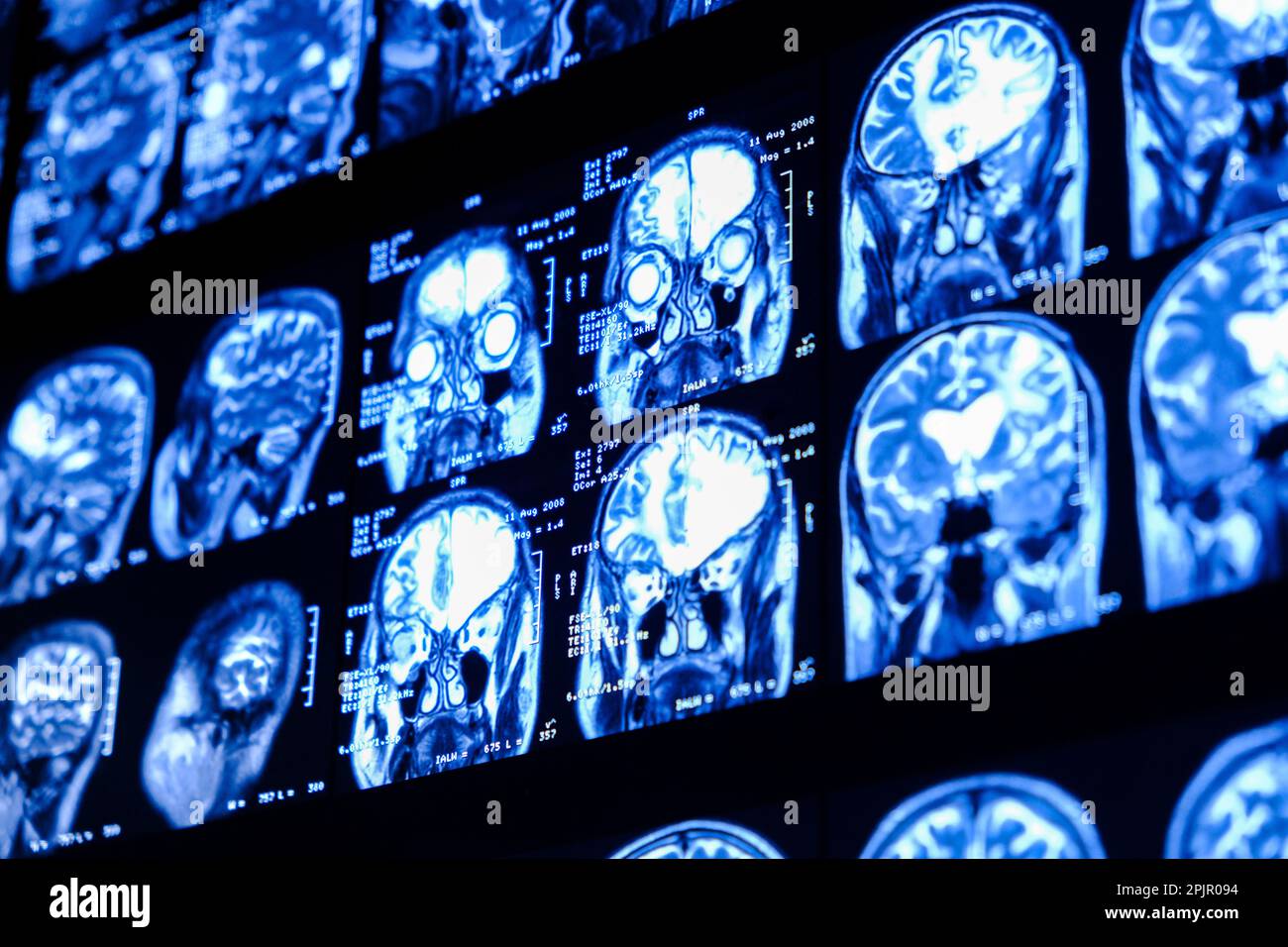 MRI scan of the brain for diagnosis. Medical examination for health prevention. Tomography shot. Close up of a CT scan with brain. Stock Photo