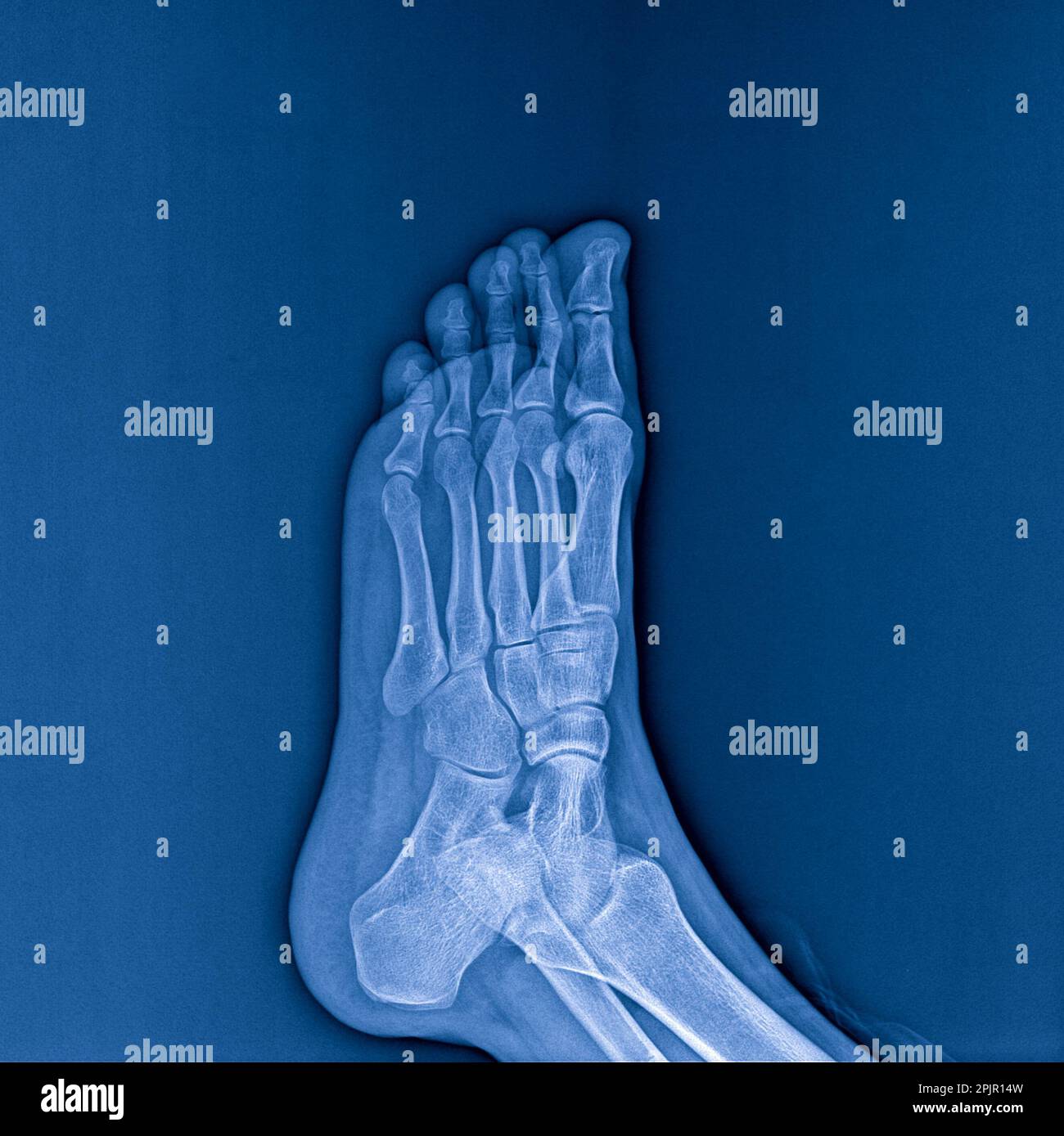 X-ray of foot on dark background, radiograph Stock Photo - Alamy