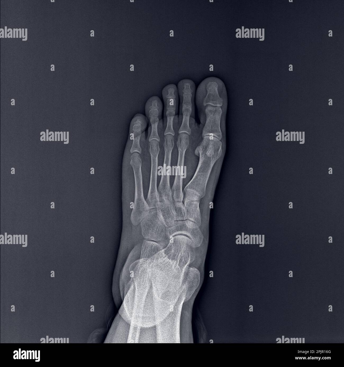 X-ray of foot on dark background, radiograph Stock Photo - Alamy