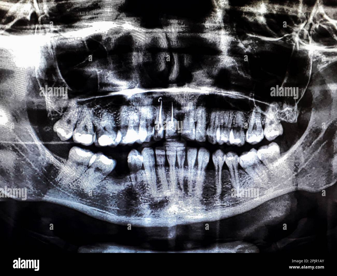 Panoramic dental tooth Xray. Radiography for dental structures research concept Stock Photo Alamy