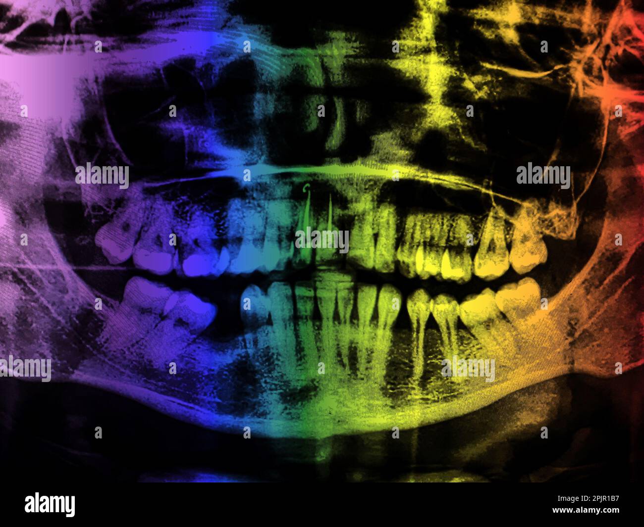 X-ray teeth mandible human skull. Panoramic negative photo facial image of mouth young adult female. Picture was taken on digital system equipment for Stock Photo