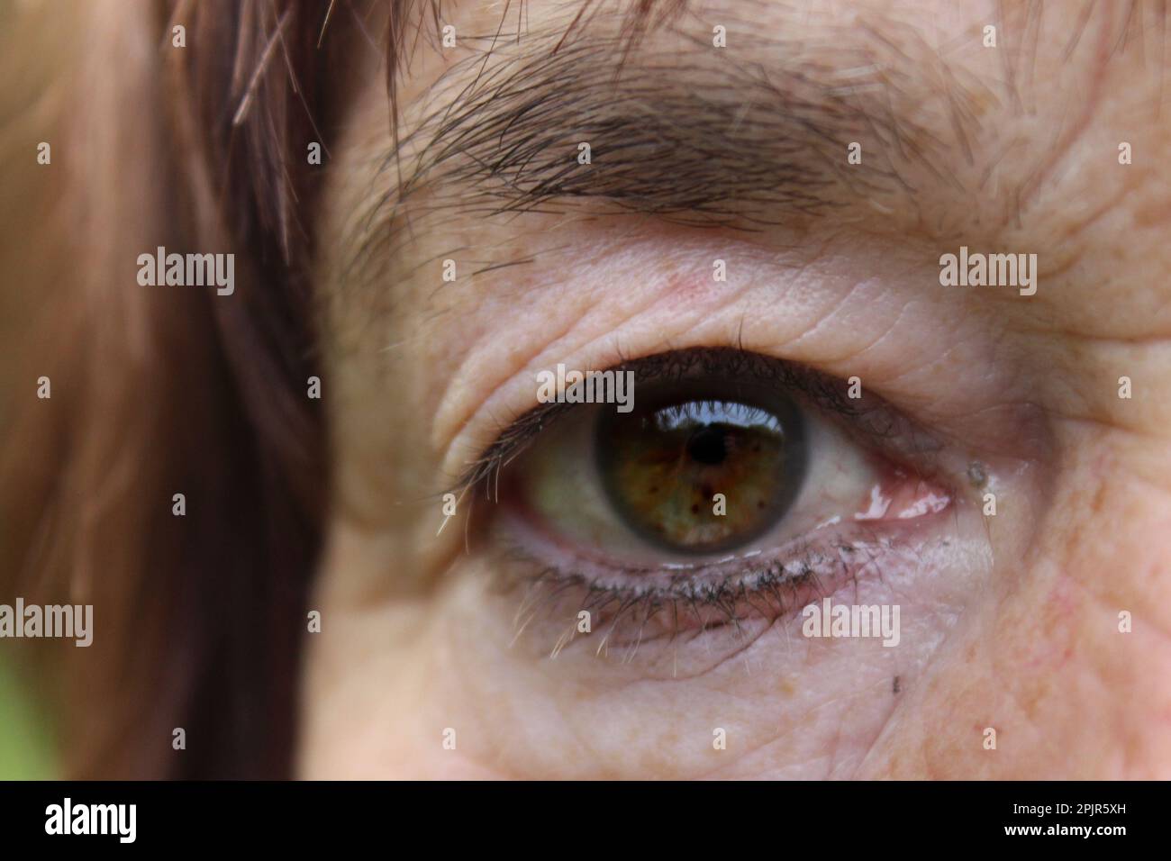 Right eye of a 60yearold caucasian woman with artificial lens after