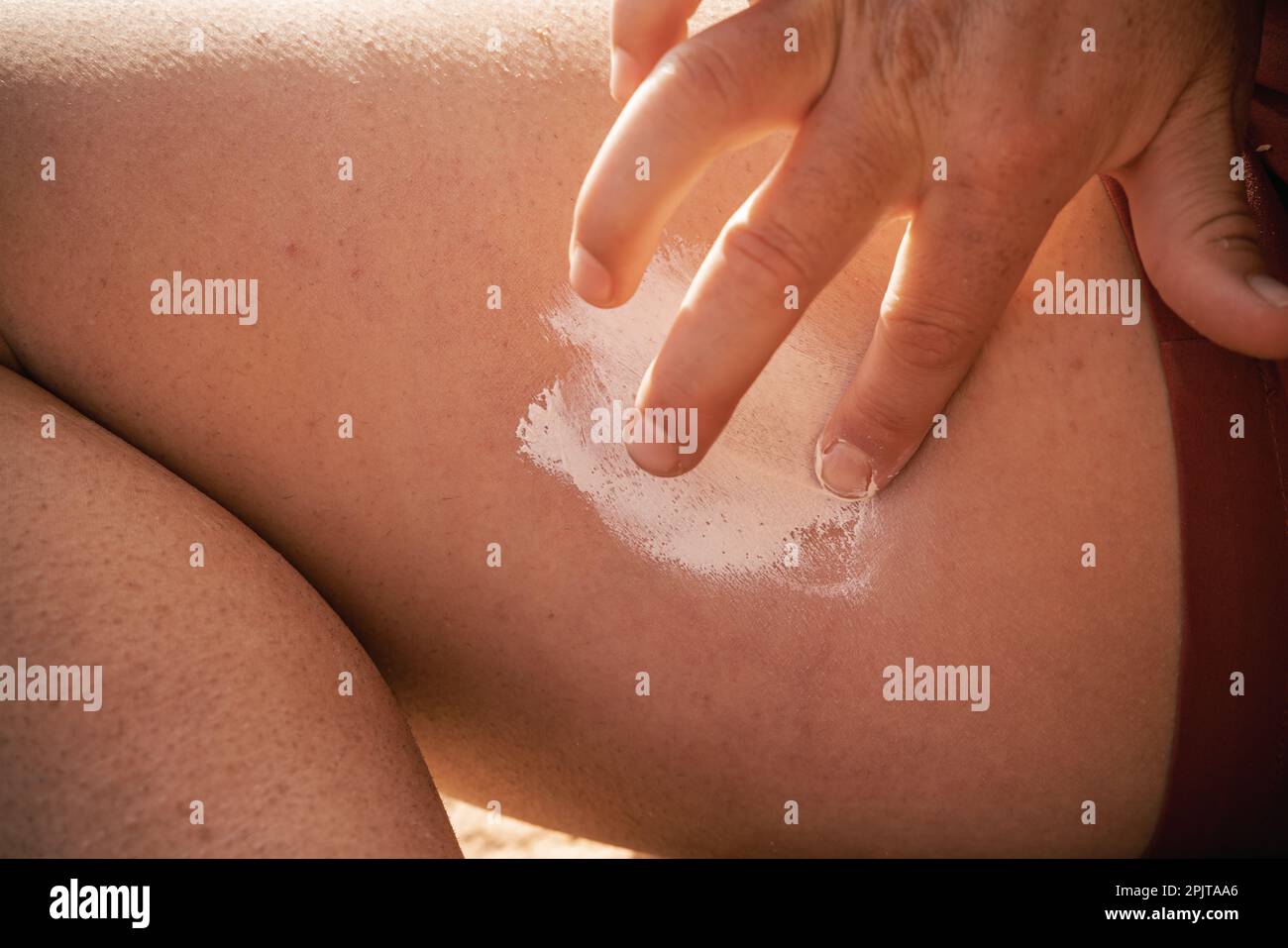 Young caucasian woman hiker in wilderness in her 30s applies pinkish white cream to skin with hand and fingers because of rash or chaffing. Stock Photo