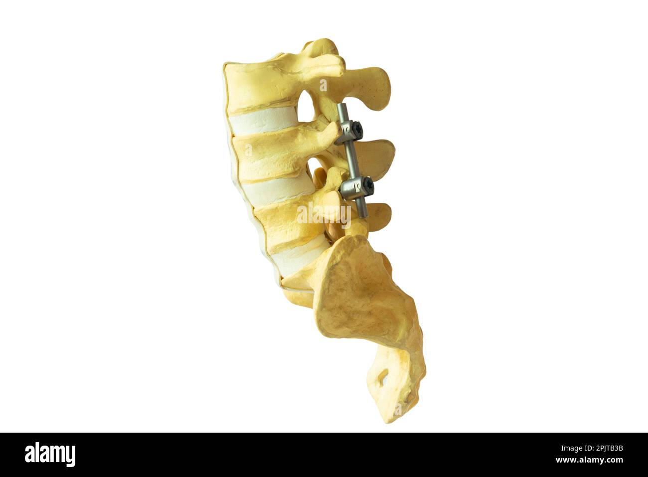 Lateral view lumbra spine model with rod and screw instrument fixation isolated on white background. Stock Photo
