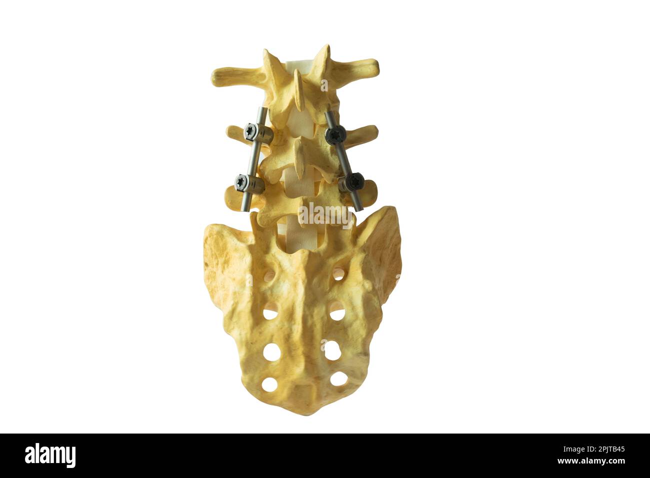 Lumbra spine model with rod and screw instrument fixation isolated on white background with clipping path. Stock Photo