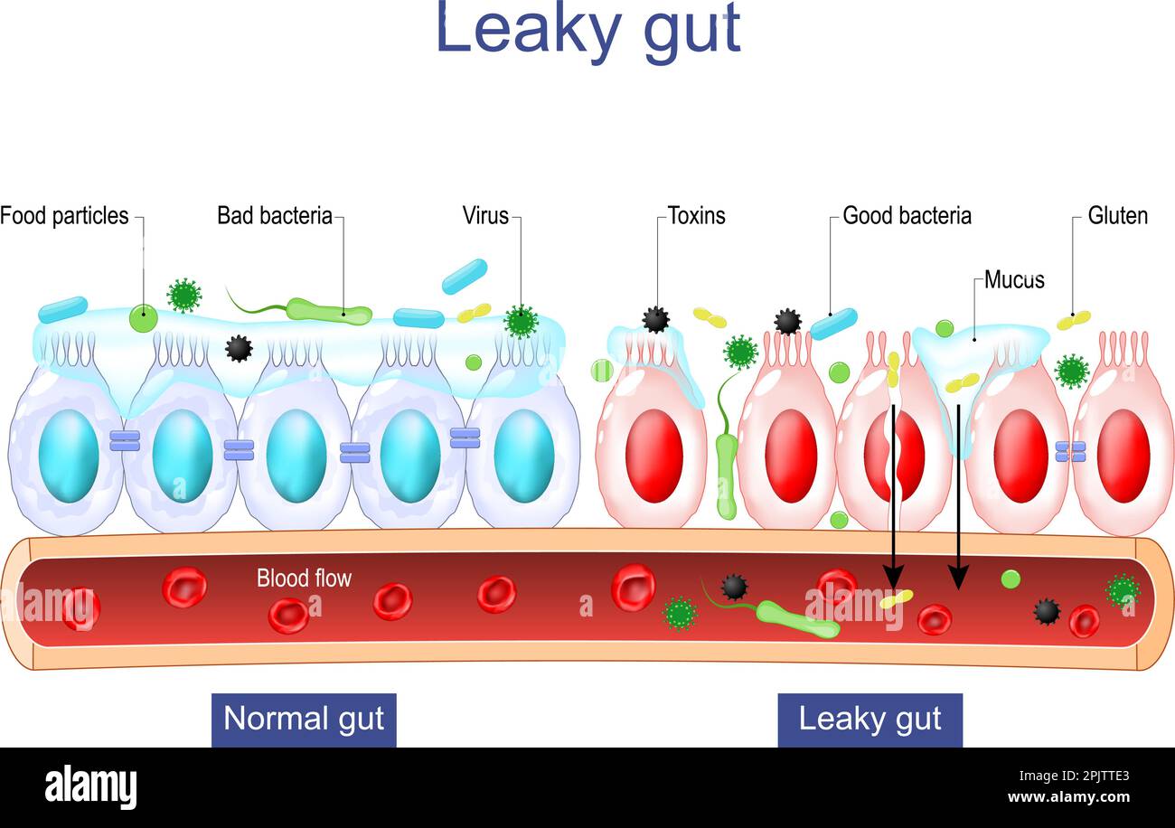 Leaky gut Syndrome. difference between Healthy cells, and inflamed intestinal cells. Comparison normal tissue of the gastrointestinal tract Stock Vector