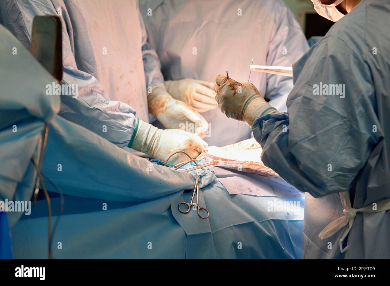 closeup hands of pediatric surgeons perform surgery using laparoscopic