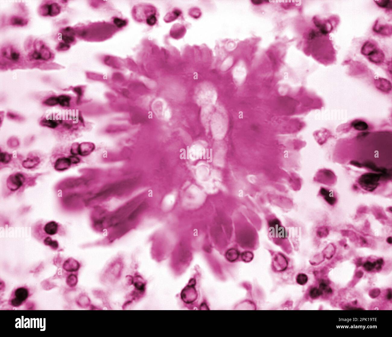 Candida albicans fungus in liver tissue, light micrograph Stock Photo Alamy