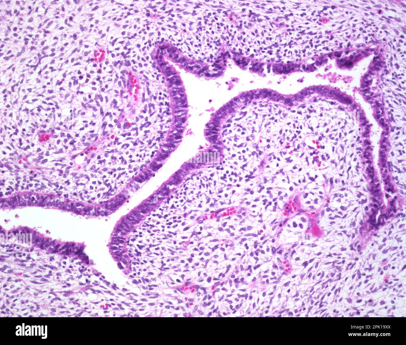 Adenosarcoma of uterus, light micrograph Stock Photo - Alamy