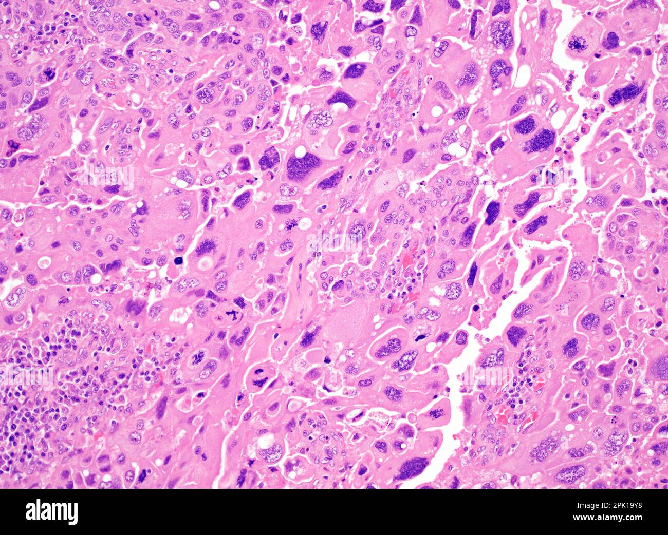 Endometrioid carcinoma of the uterus, light micrograph Stock Photo - Alamy