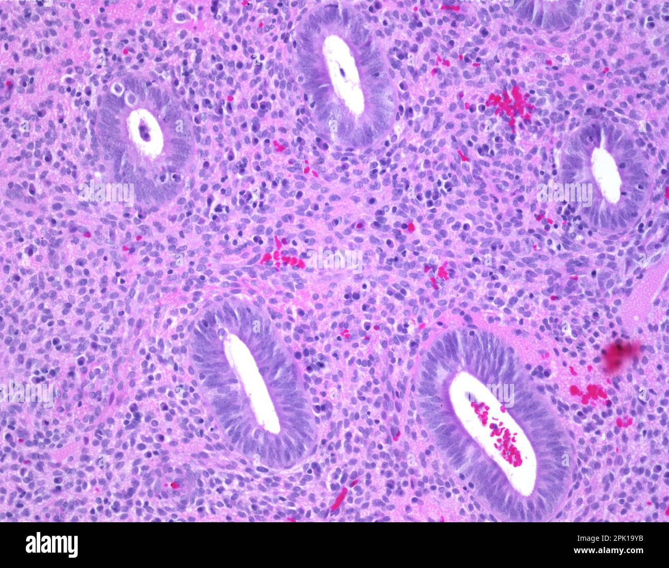 Chronic endometritis, light micrograph Stock Photo Alamy