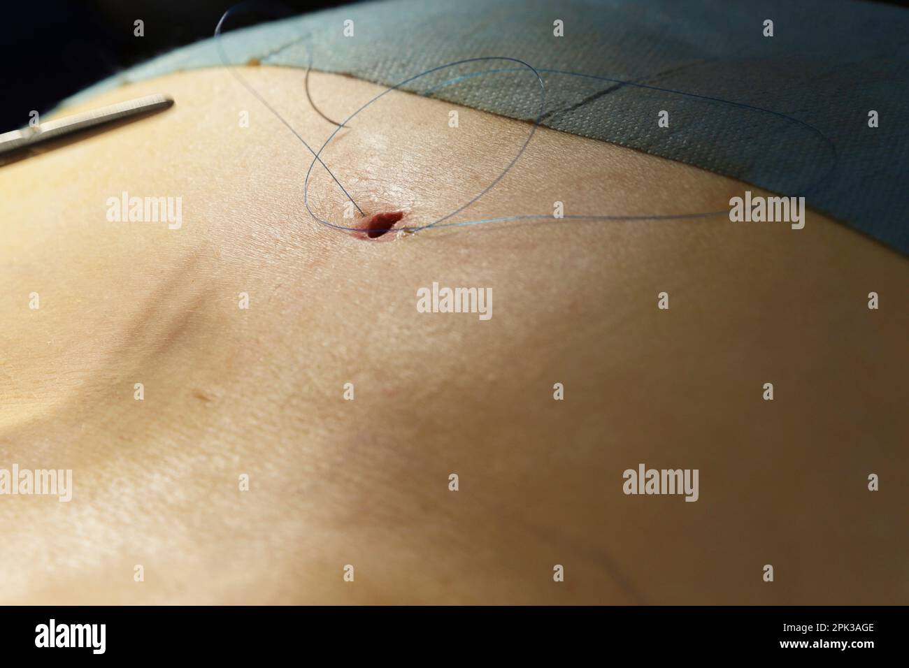 suturing a wound in the operating room Stock Photo