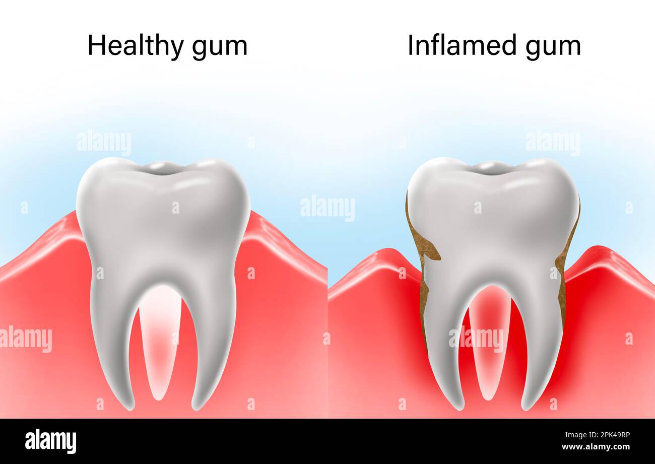 Collage with illustrations of healthy tooth with gum and diseased ones. Gingivitis and