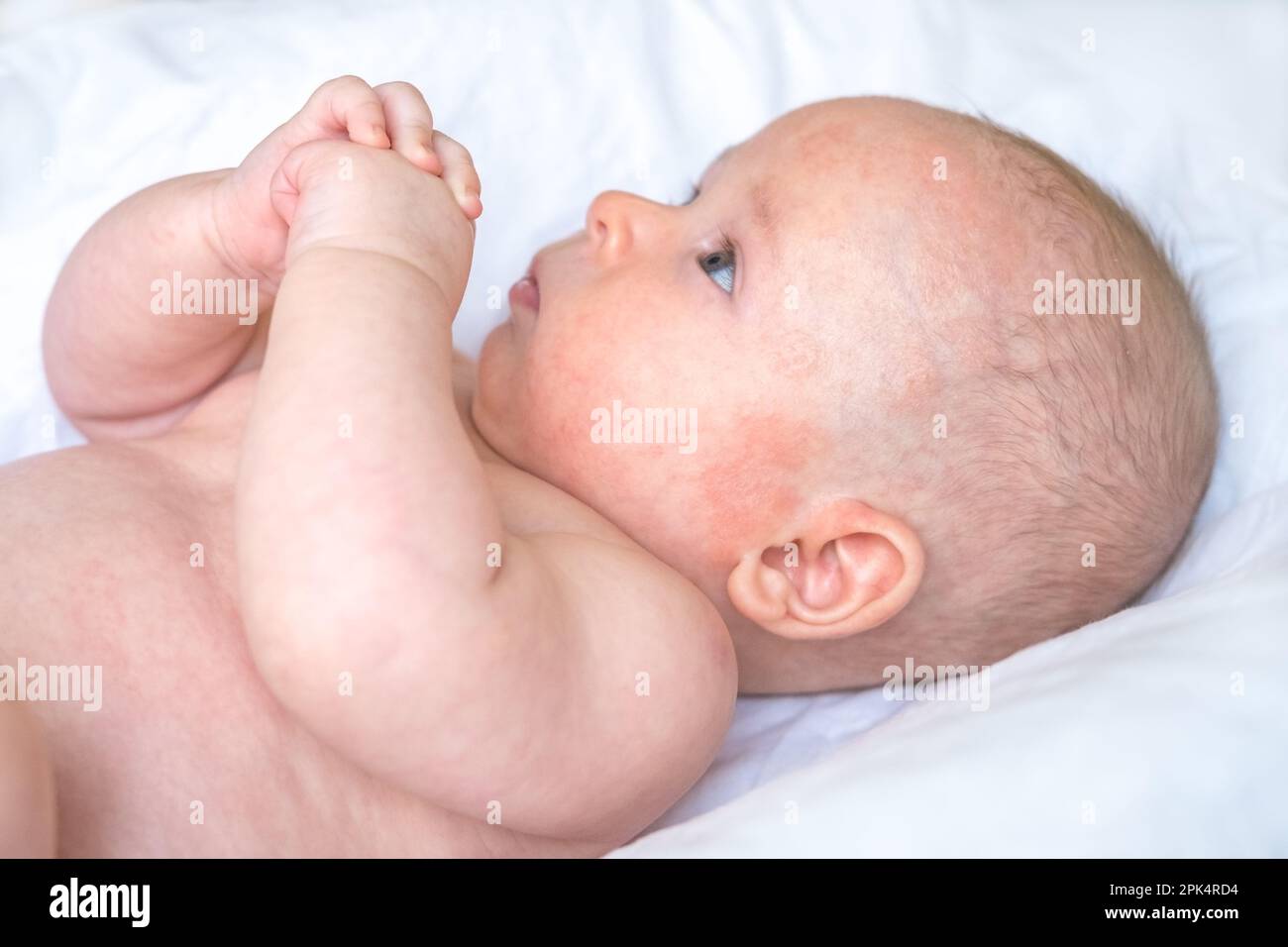 a-baby-boy-with-red-irritated-marks-near-left-ear-and-cheek-atopic