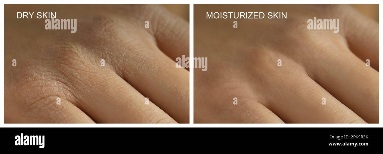 Collage with photos of person with dry and moisturized skin, closeup ...