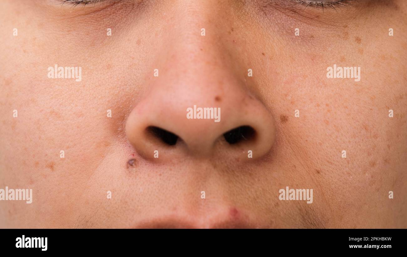Close-up of freckles on Asian woman's face. Middle-aged woman with wrinkles, blemishes, dark spots, freckles, dry skin on her face. Skin care problems Stock Photo