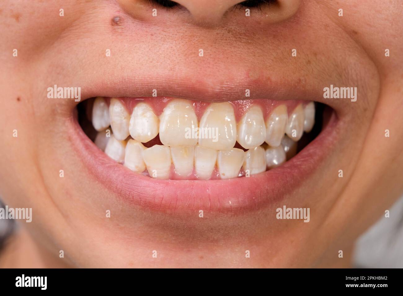 Close-up of a smiling woman's teeth revealing white spots and plaque on the tooth surface. Oral care and Dental concept. Stock Photo